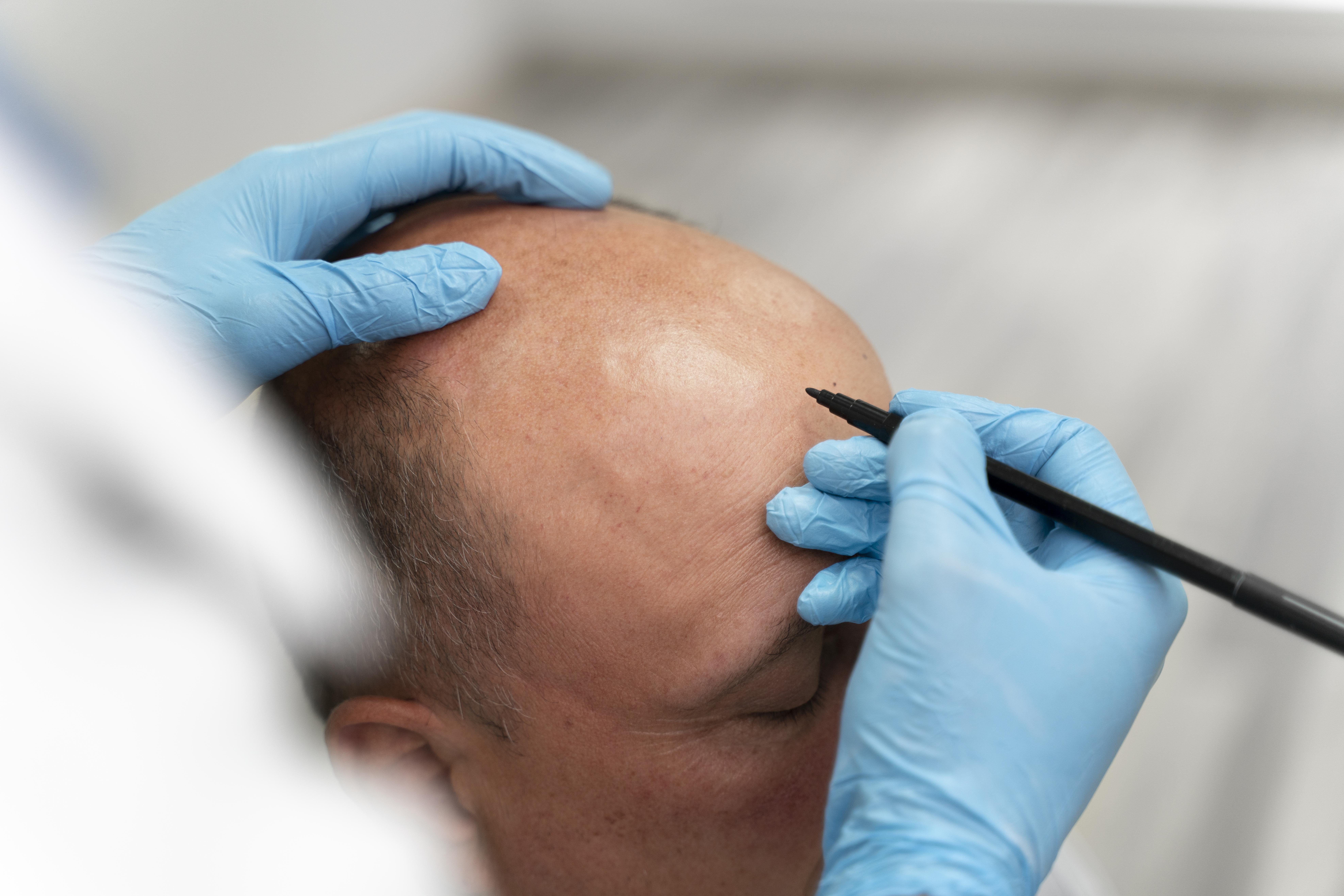 Hair transplant planning tools