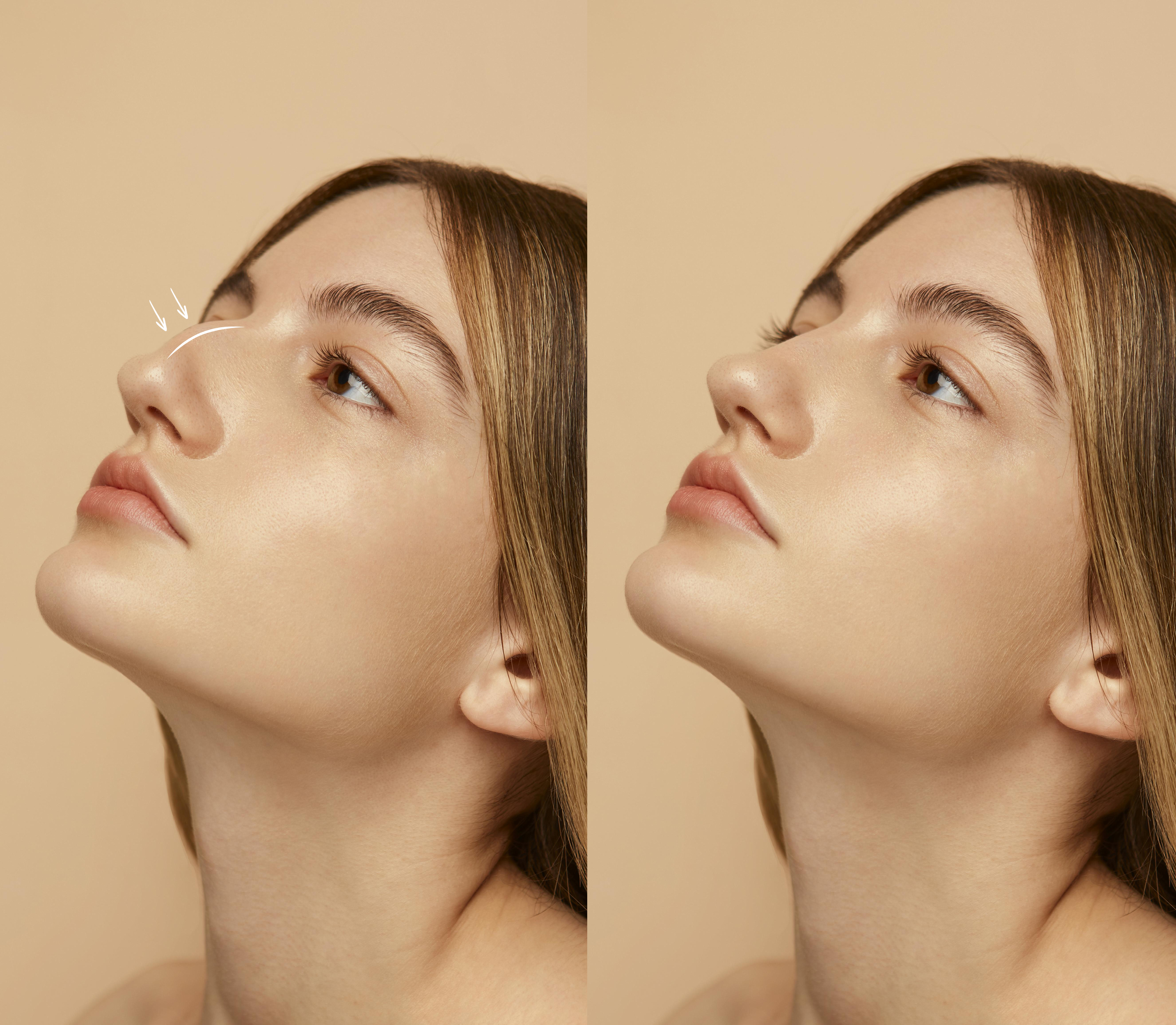 Profile reference used for rhinoplasty planning