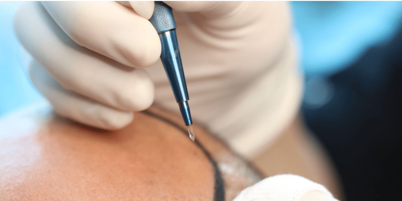 Setup for FUE extraction and placement